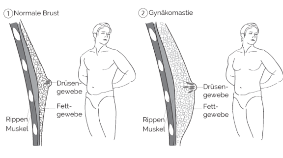 Gynäkomastie, prevention-center für Schönheitschirurgie in St. Gallen